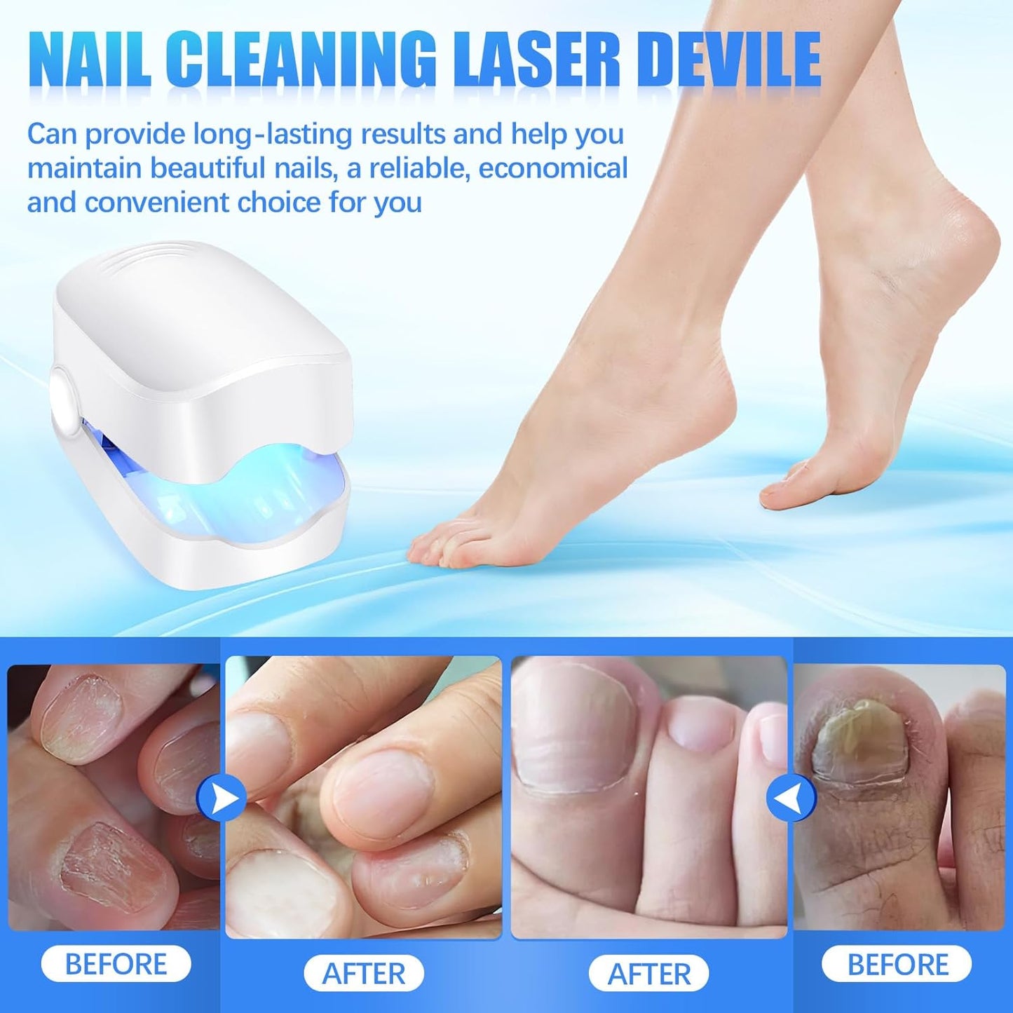 Rechargeable Nail Fungus Treatment For Toenail Toe Nail Fungal Treatment Nail Fungus Laser Device Anti-fungal Nail Treatment For Hand  Feet Infections Remover For Home Use